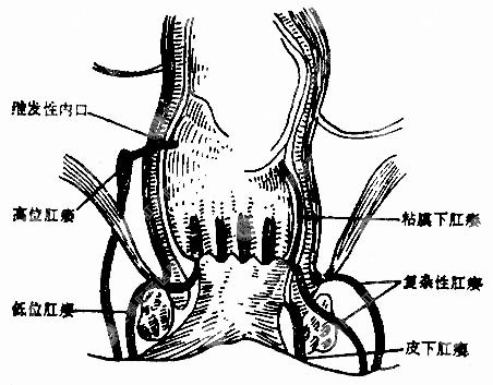 肛瘺最新治療方法，前沿技術(shù)探索與應(yīng)用